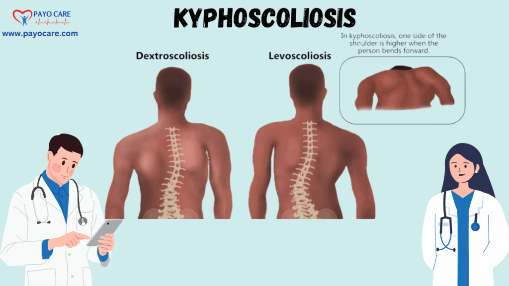 Kyphoscoliosis: Causes, Symptoms, Prevention, Diagnosis, and Treatment Kyphoscoliosis: Causes, Symptoms, Prevention, Diagnosis, and Treatment